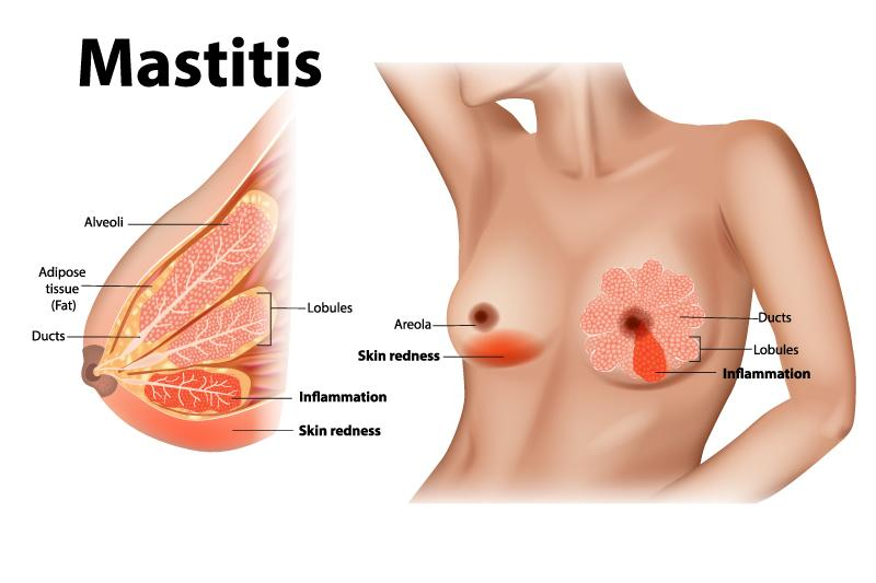 Illustration Comment traiter une mastite ? 