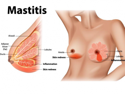 Illustration Comment traiter une mastite ? 